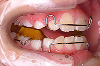 顎機能的矯正装置（ツインブロック）