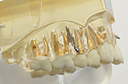 歯科矯正用アンカースクリューの模型